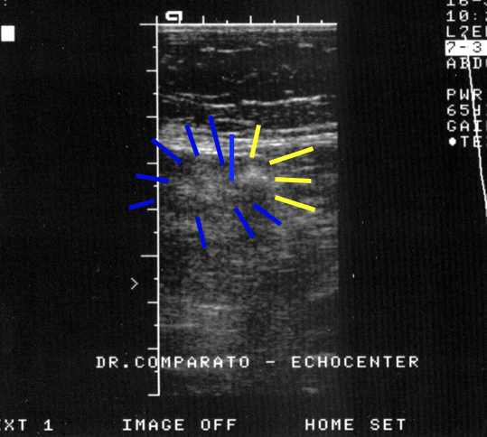 diverticolo sigma