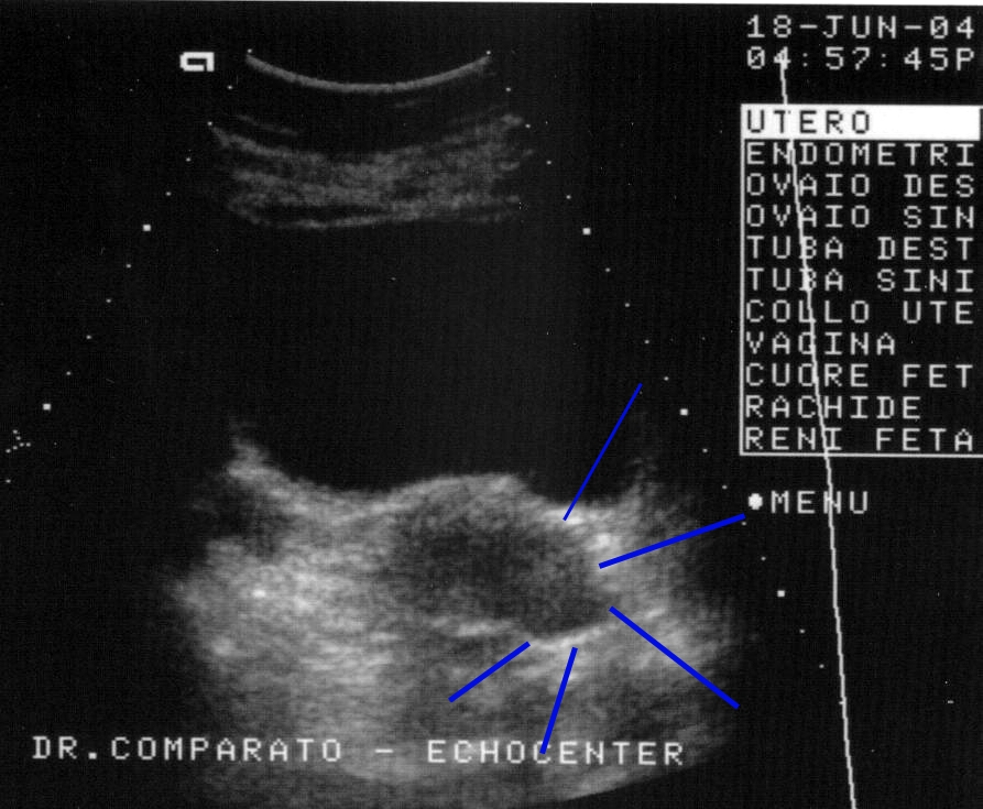 falso fibroma