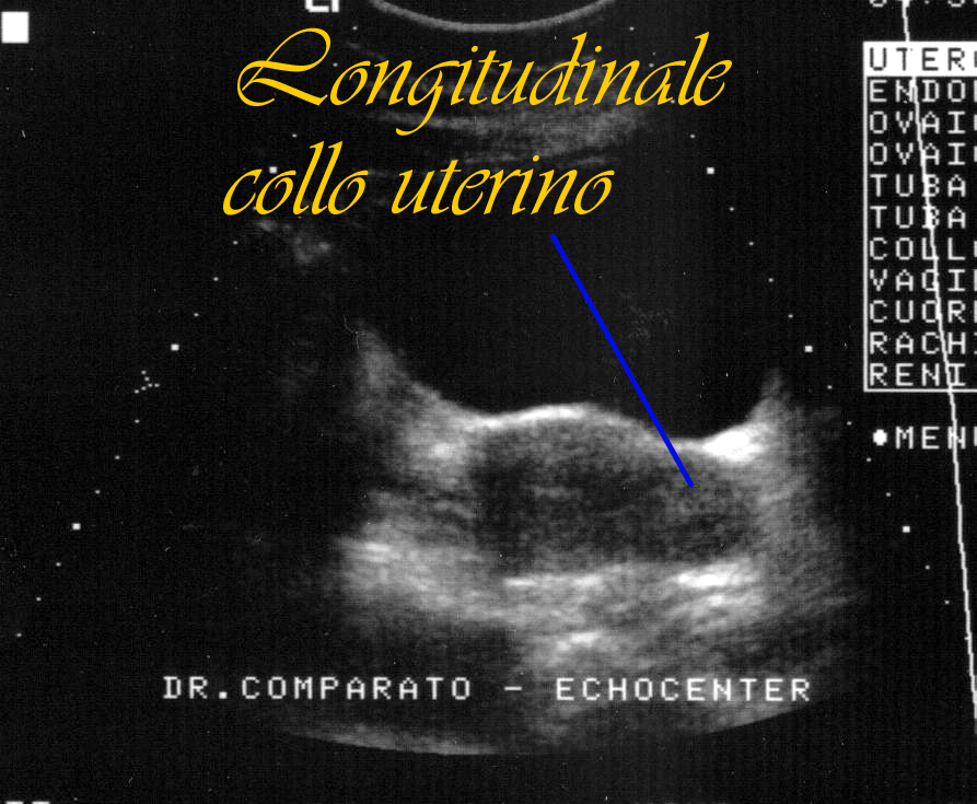 falso fibroma1